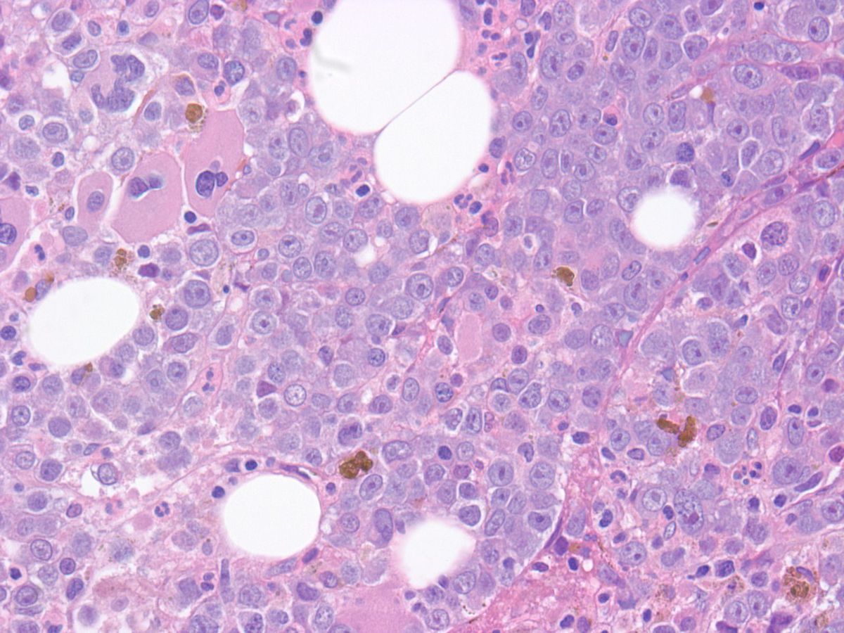 Bone marrow Biopsy: sheets of pronormoblasts